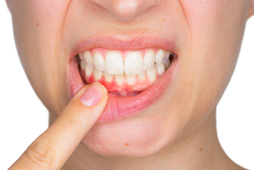 Konya Diş Eti Tedavisi ve Hastalıkları – Periodontoloji