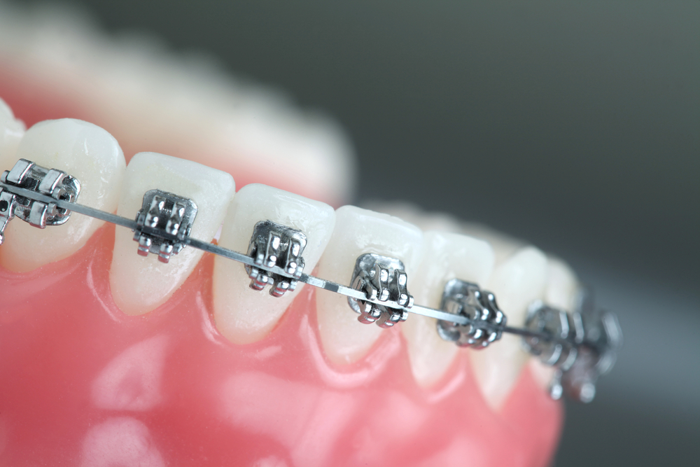 Konya Ortodonti Tedavileri